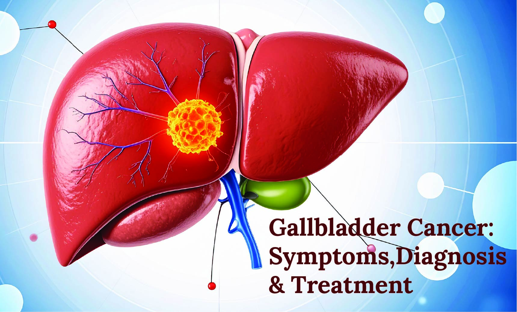 Gallbladder Cancer: Symptoms, Diagnosis & Treatment