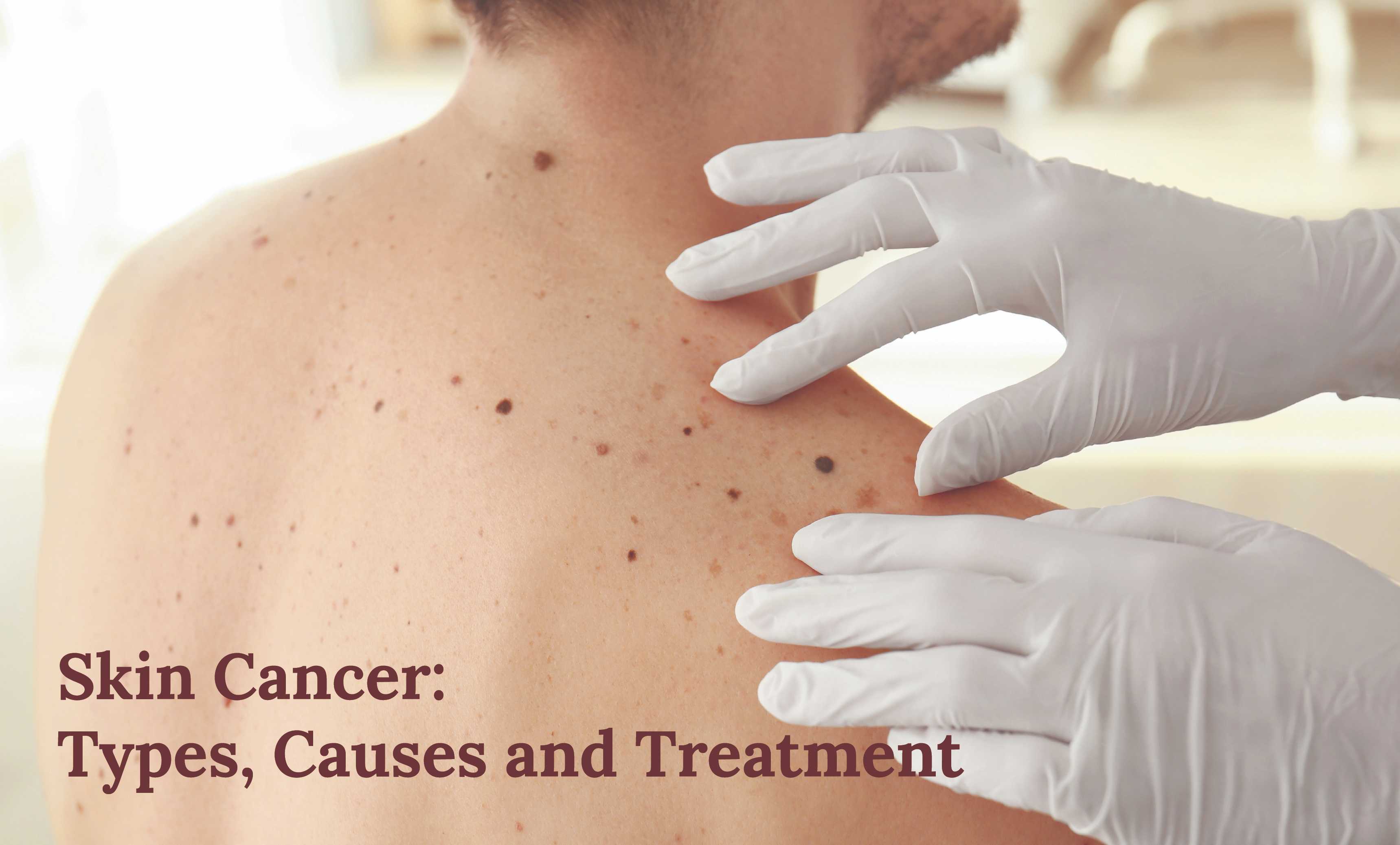 Skin Cancer: Types, Causes and Treatment | Dr. Priya Tiwari