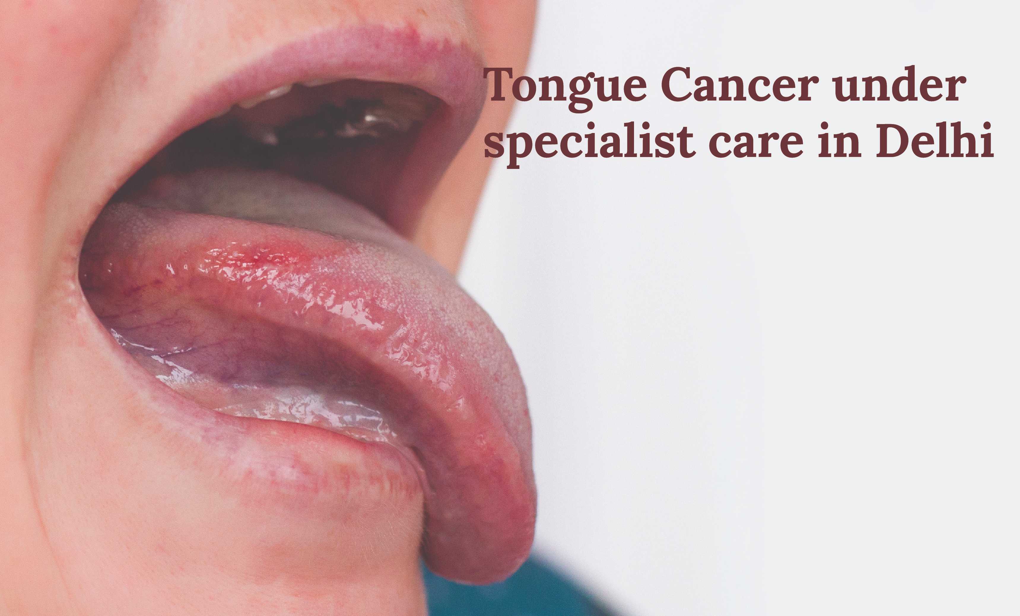 Tongue Cancer under specialist care in Delhi