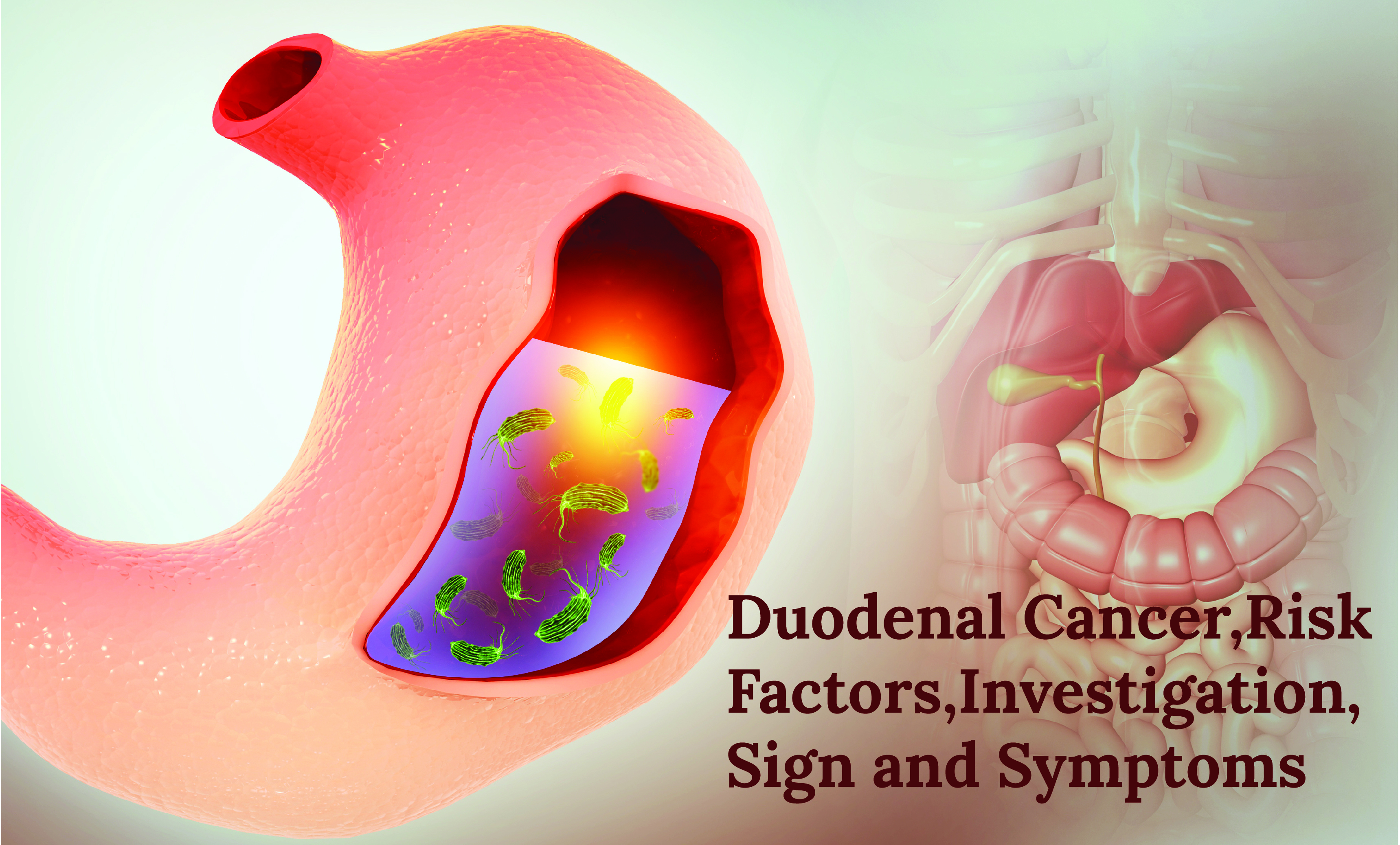 Duodenal Cancer, Risk Factors, Investigation,Sign and Symptoms