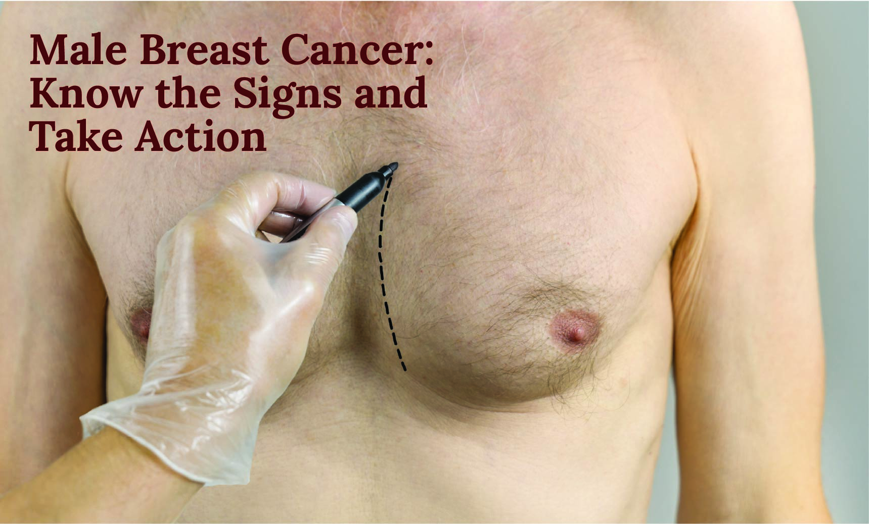 Male Breast Cancer: Know the Signs and Take Action | Dr. Priya Tiwari, Delhi
