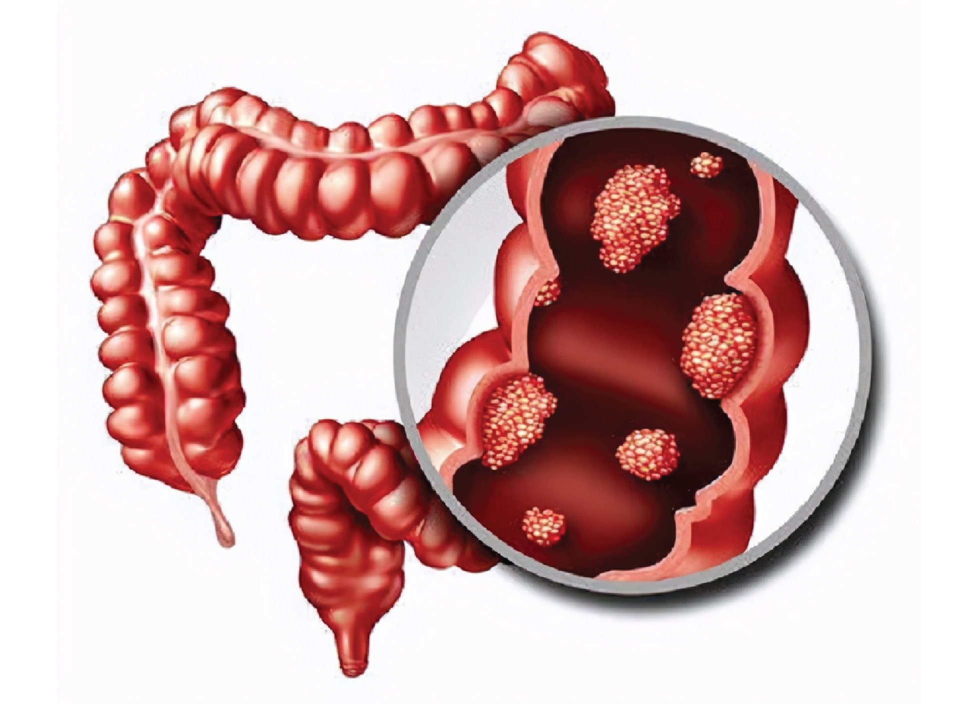 Colon-Cancer-Specialist-In-Delhi