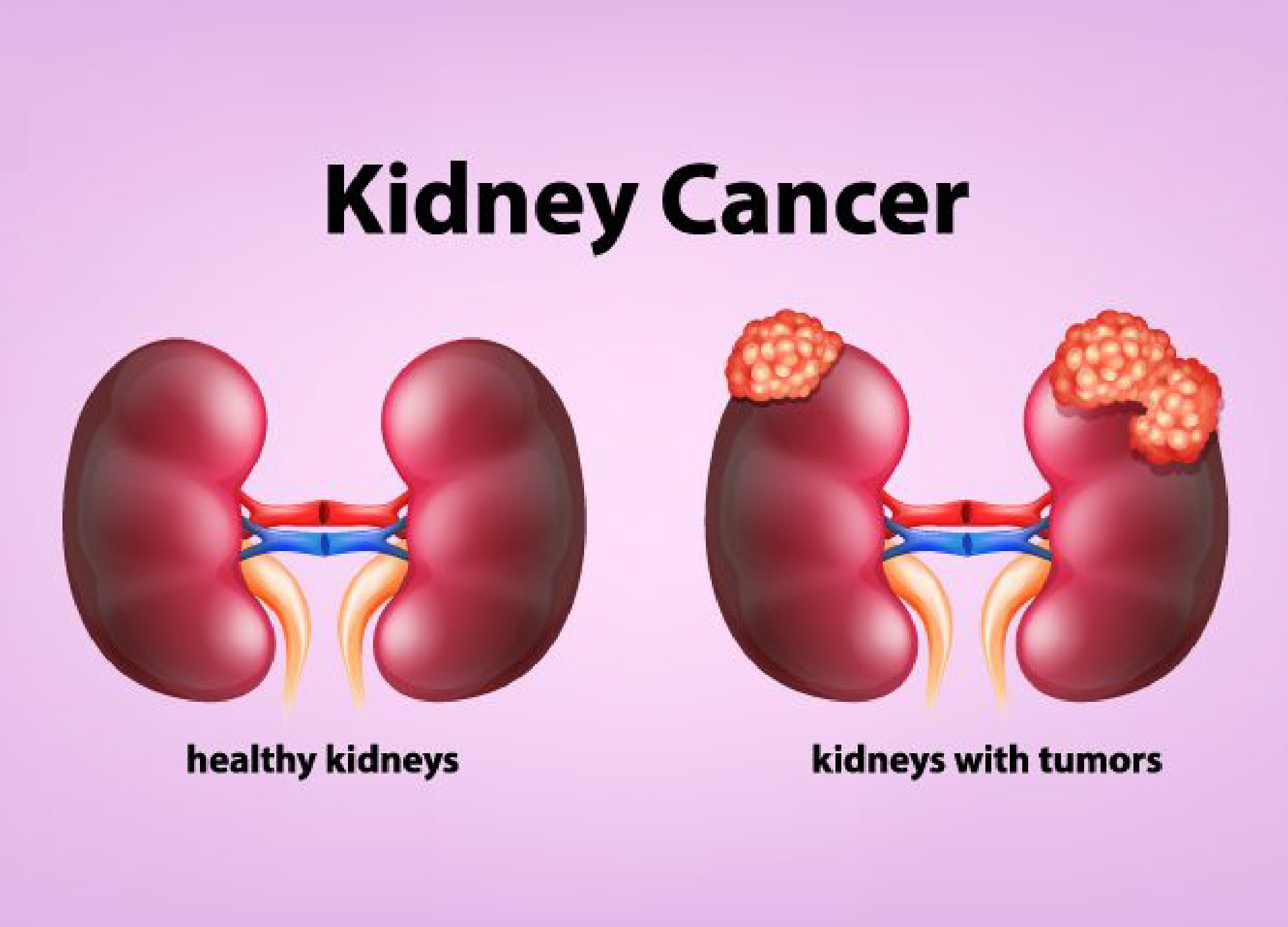Kidney Cancer Treatment In Delhi